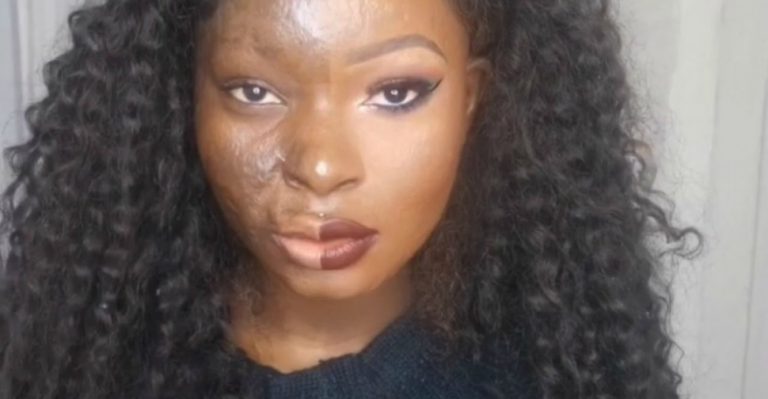 Beauty vlogger met brandwonden deelt verhaal