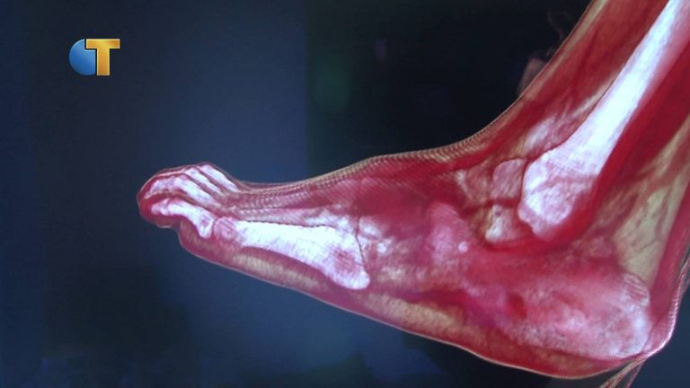 Zwitserse subsidie voor onderzoek gecompliceerde bekkenbreuken